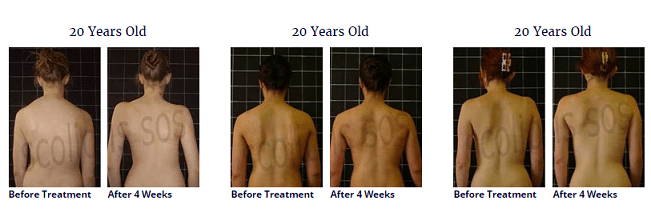 scoliosis treatment for a 20 year old